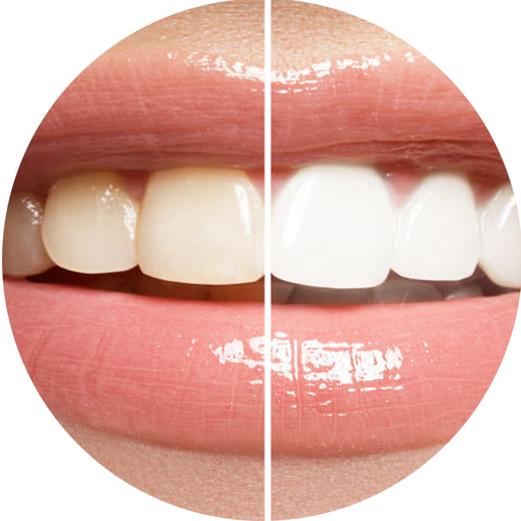 Blancamiento dental